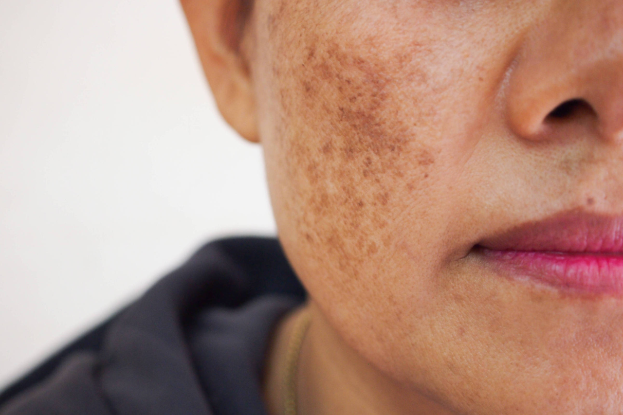 Rosto de mulher com manchas de melasma