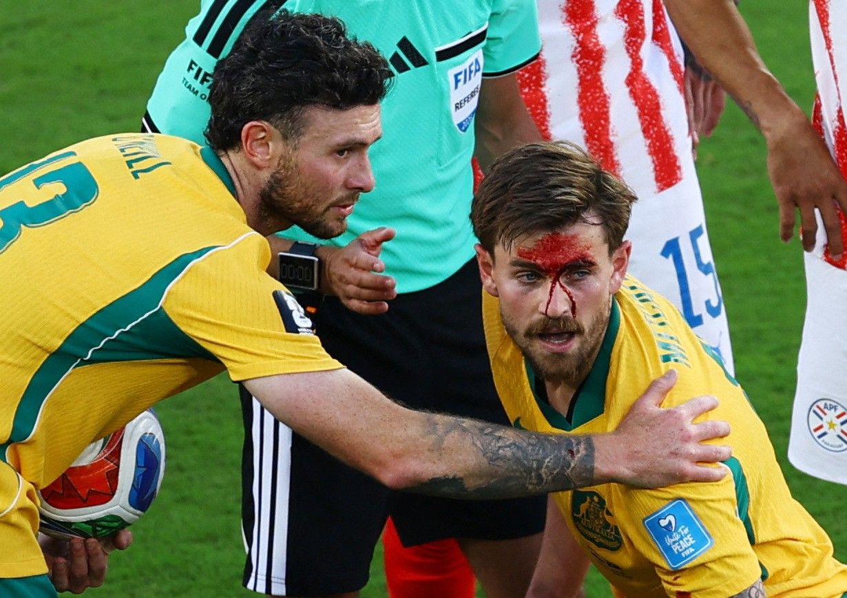 Connor Metcalfe com corte no rosto