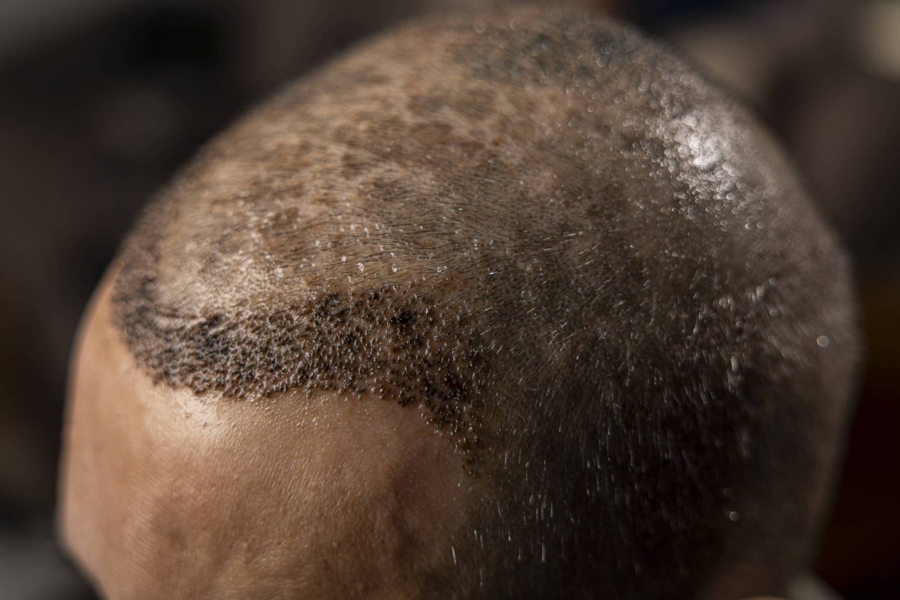 Paciente em recuperação pós-transplante capilar