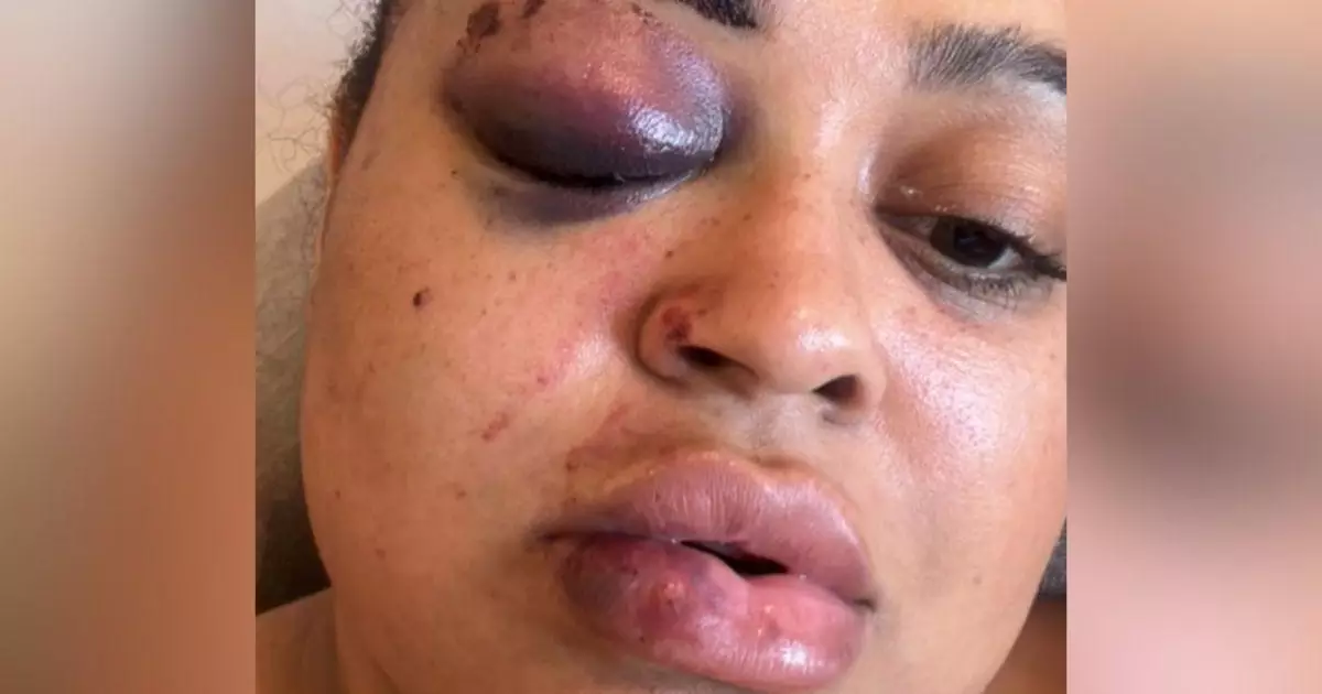 Rízia Cerqueira com machucados no rosto após a queda