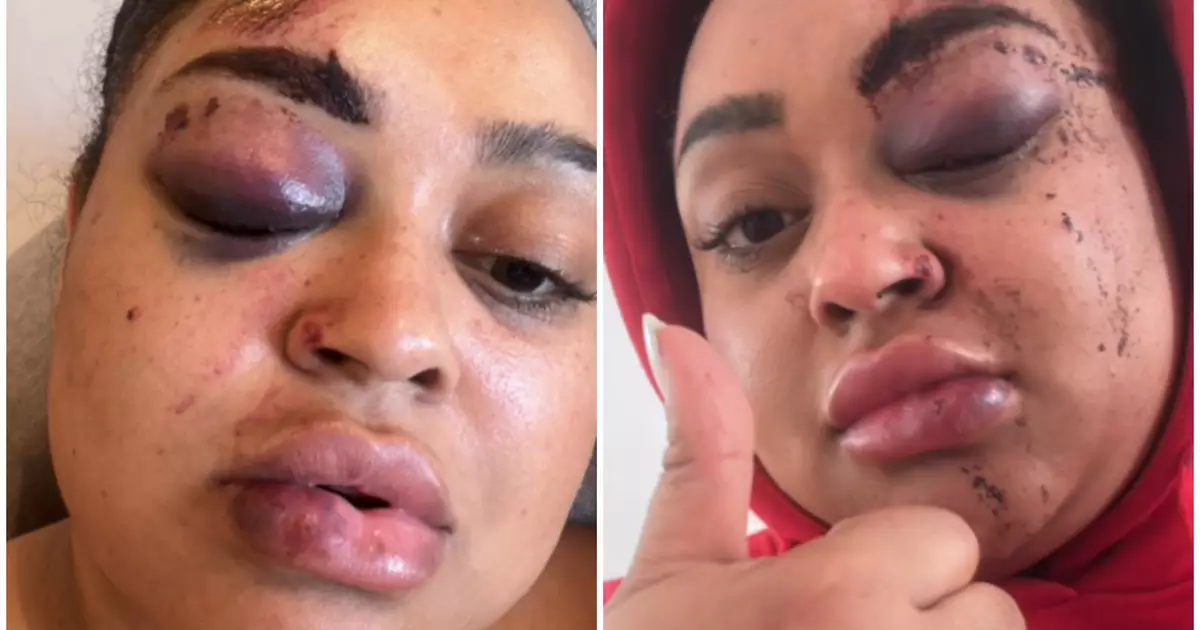 Rízia Cerqueira mostra ferimentos após acidente de moto elétrica