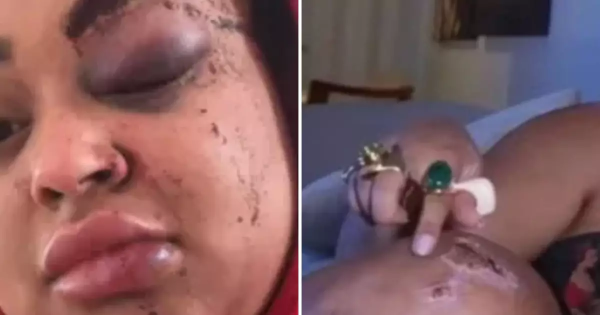 Rízia Cerqueira mostrando hematomas no rosto após acidente