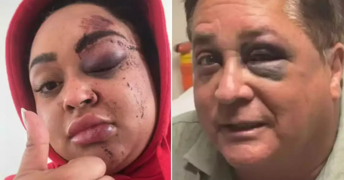 Rízia Cerqueira mostrando machucado no olho