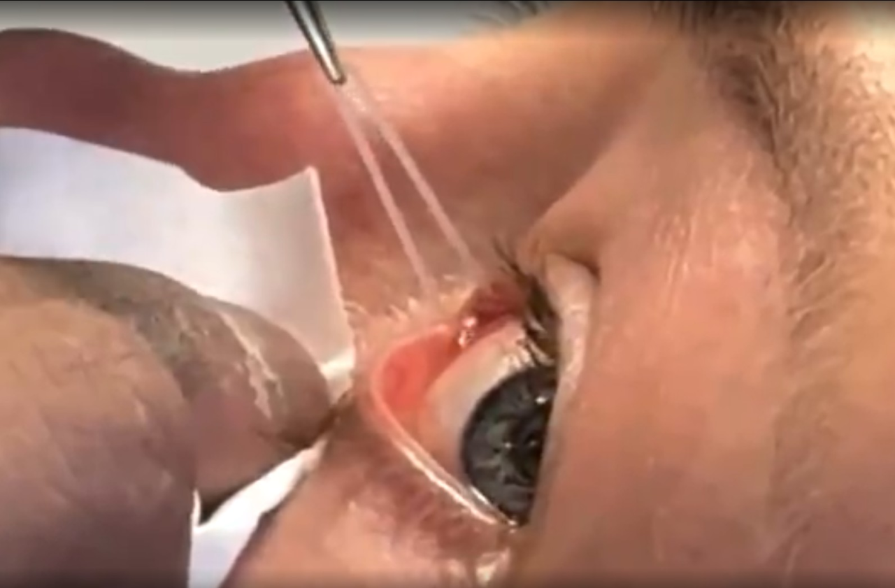 Rose Namajunas após procedimento no olho esquerdo